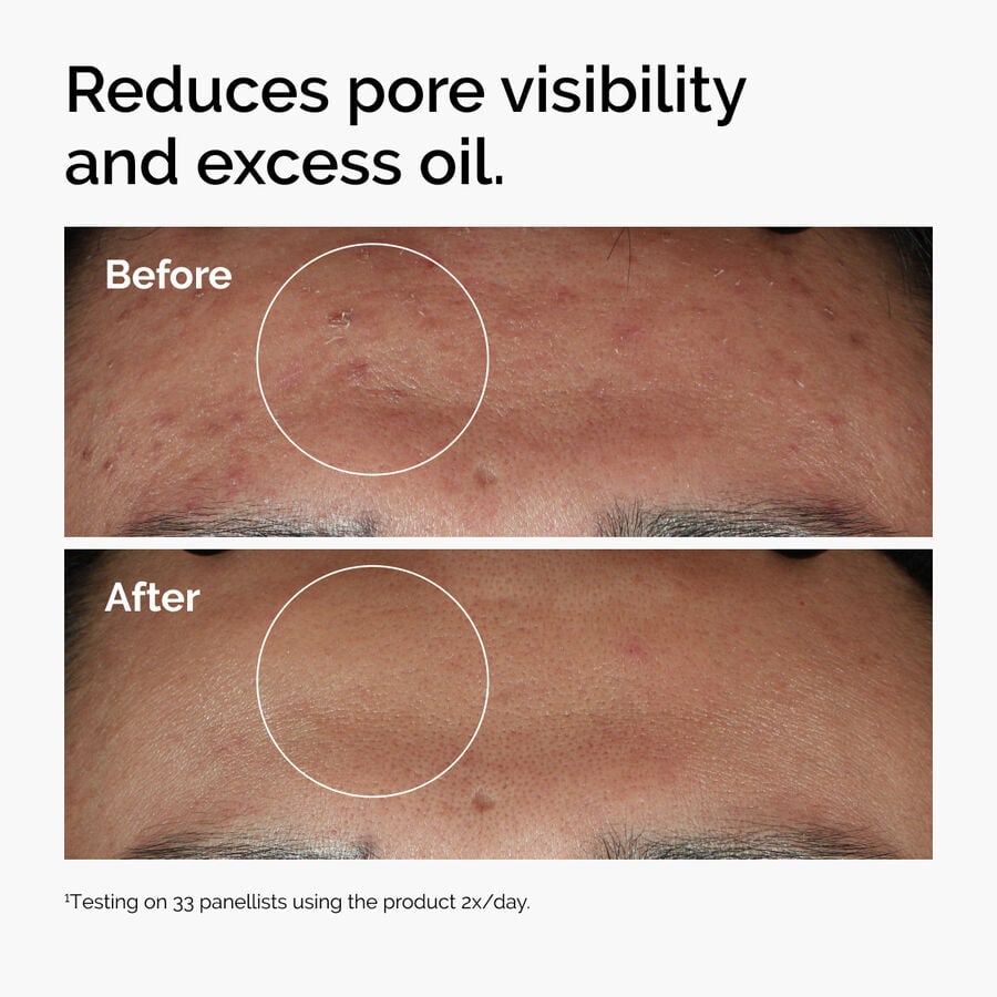 niacinamide-10-zinc-1-z4 ord-niacinamide-zinc-blemish-serum-before-after-pores.jpg