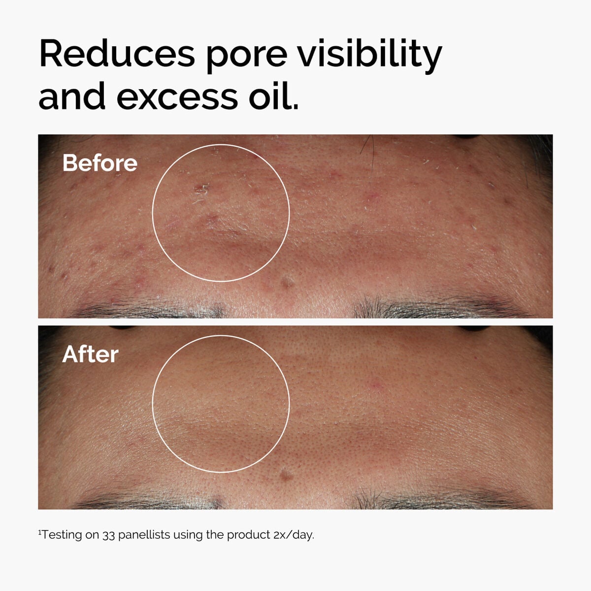 niacinamide-10-zinc-1-z4 ord-niacinamide-zinc-blemish-serum-before-after-pores.jpg