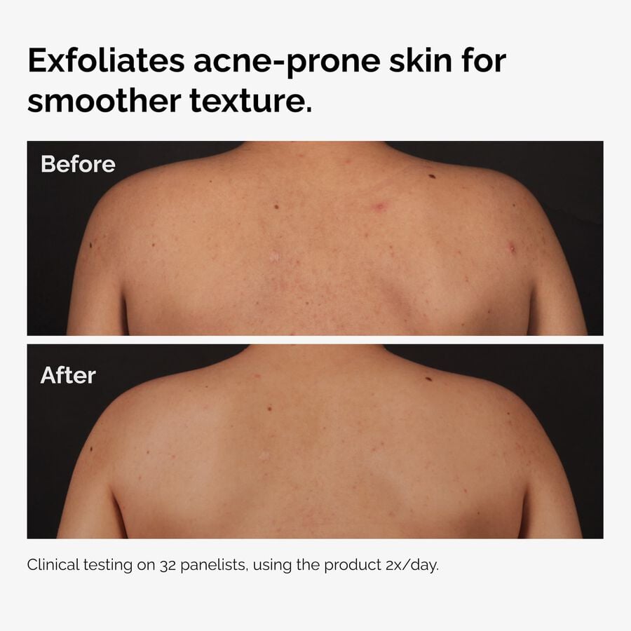 the-body-care-collection-j3 ord-salicylic-acid-body-serum-before-after-graphic-NA.jpg